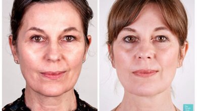 Full Face Lift Without Surgery