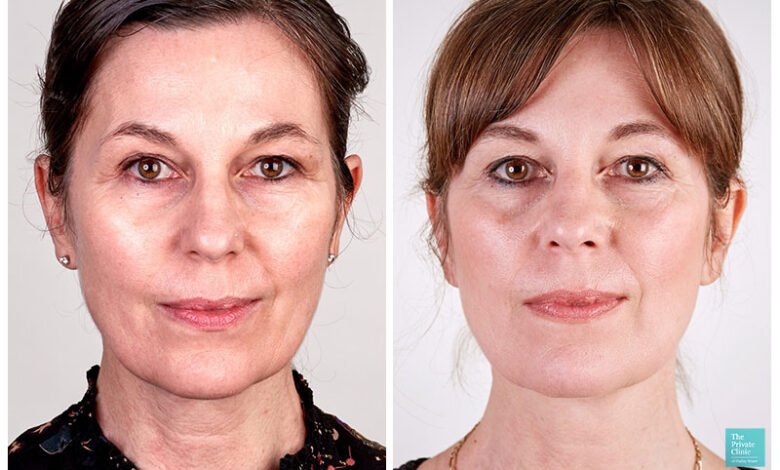 Full Face Lift Without Surgery